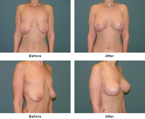 Gynecomastia before and after - before