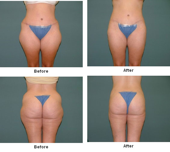 Liposuction before and after - before