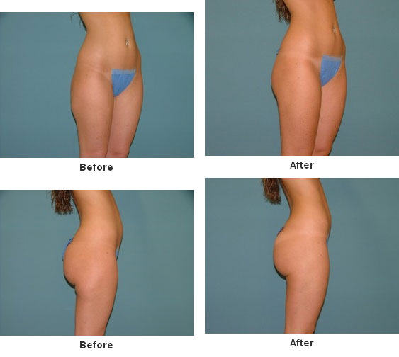 Liposuction before and after - before