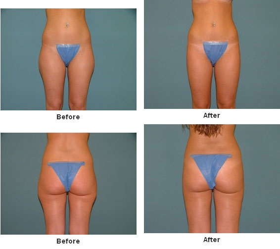 Liposuction before and after - before