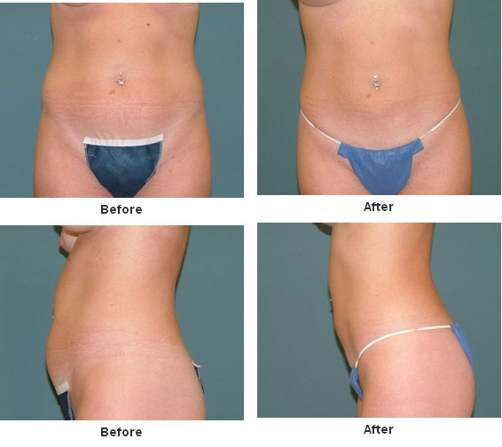 Liposuction before and after - before