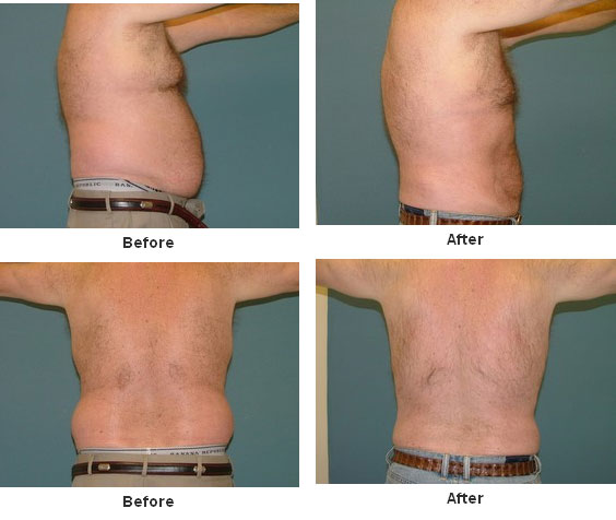 Liposuction before and after - before