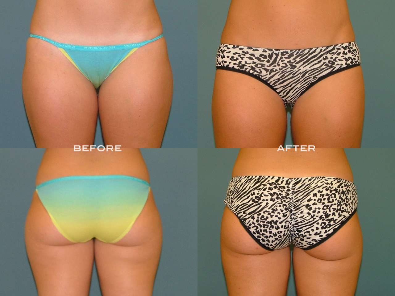 Liposuction before and after - before