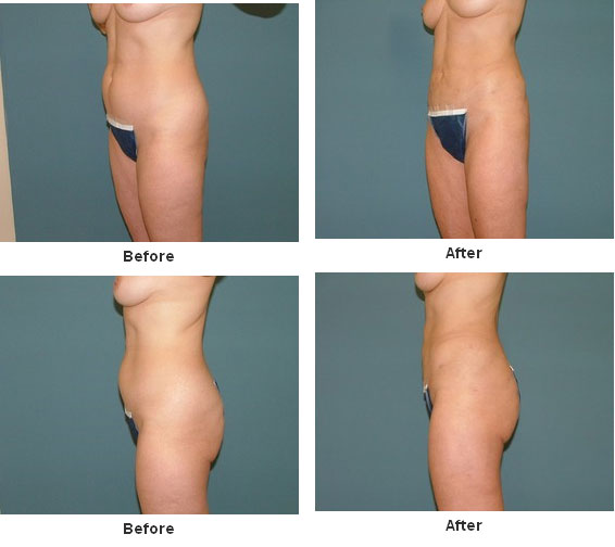 Liposuction before and after - before