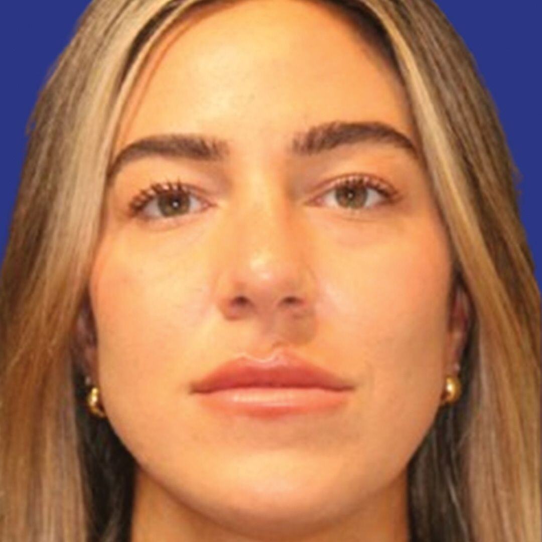 Procedure before and after - after