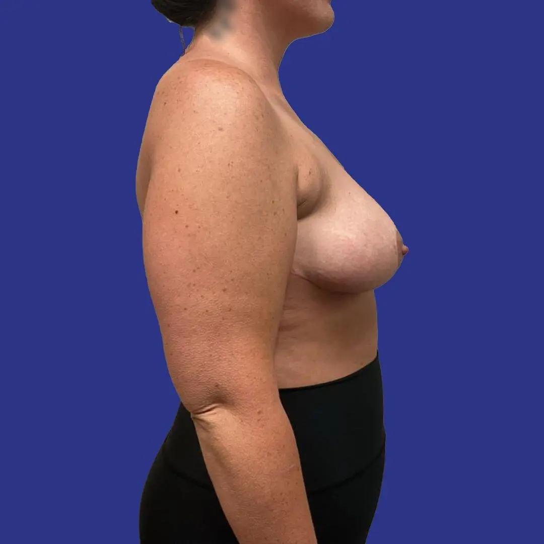 Procedure before and after - after