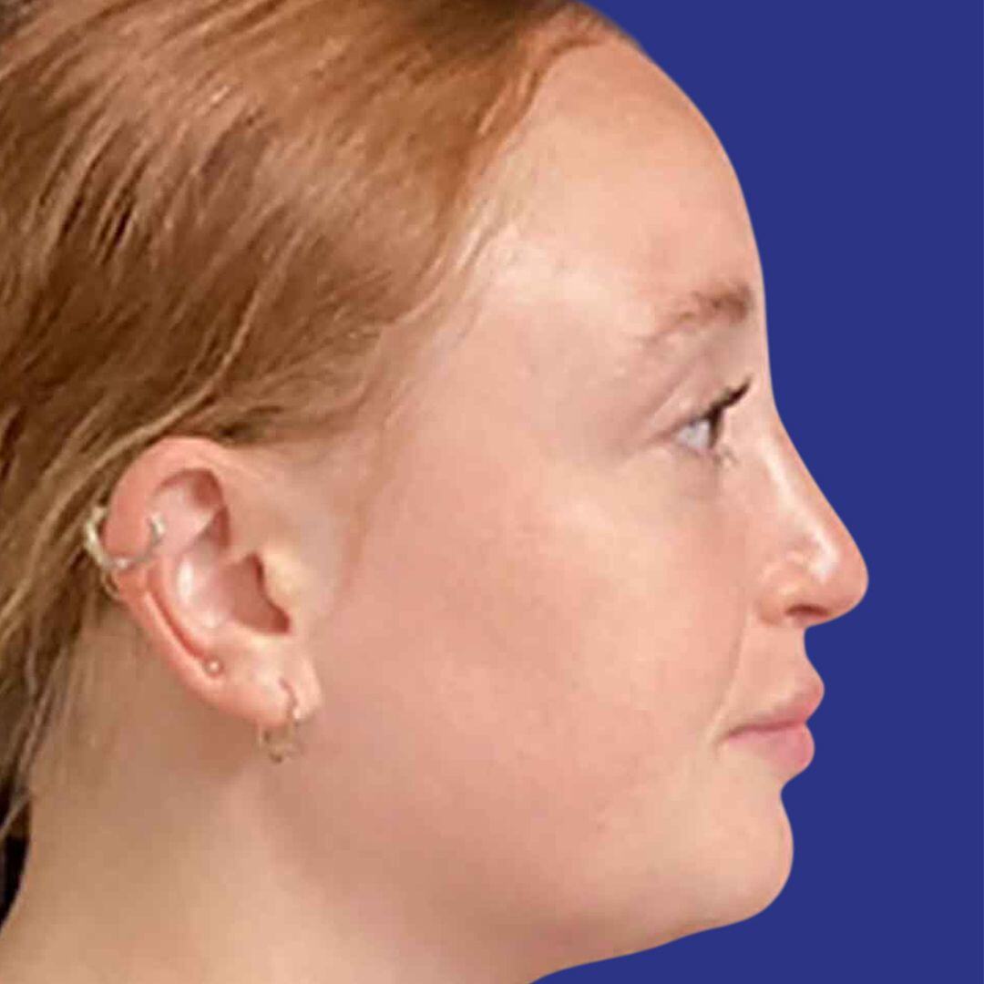 Procedure before and after - after