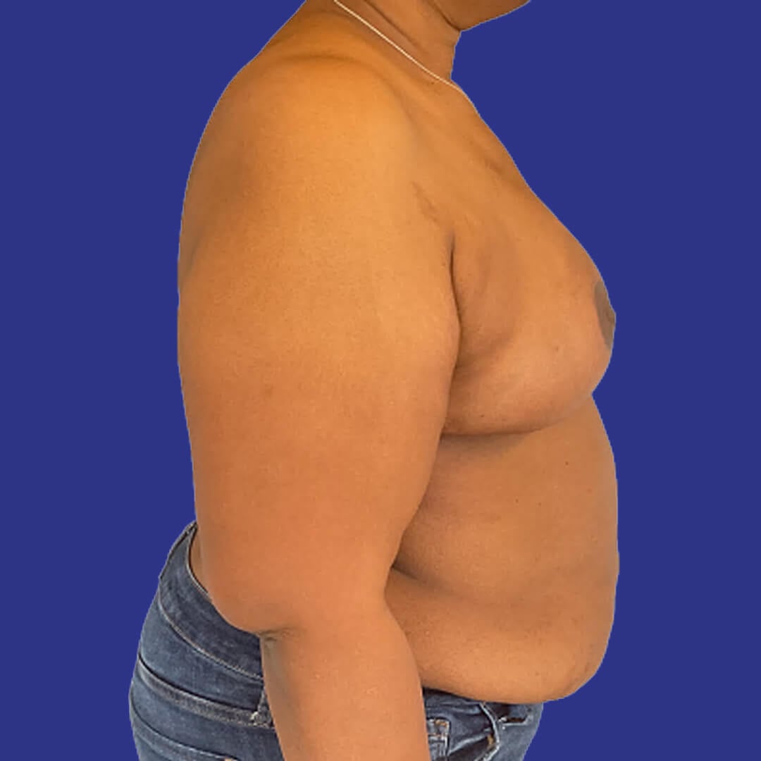Procedure before and after - after
