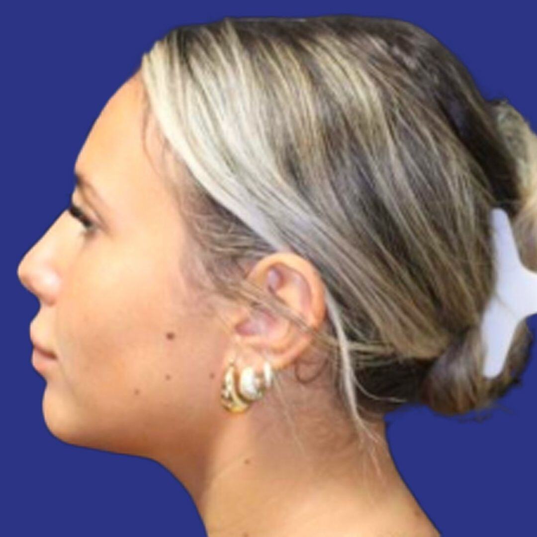 Procedure before and after - after