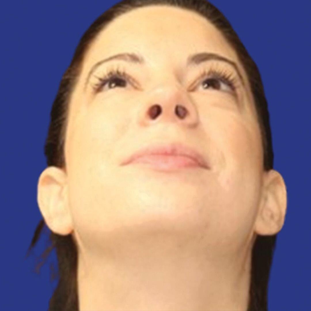 Procedure before and after - after