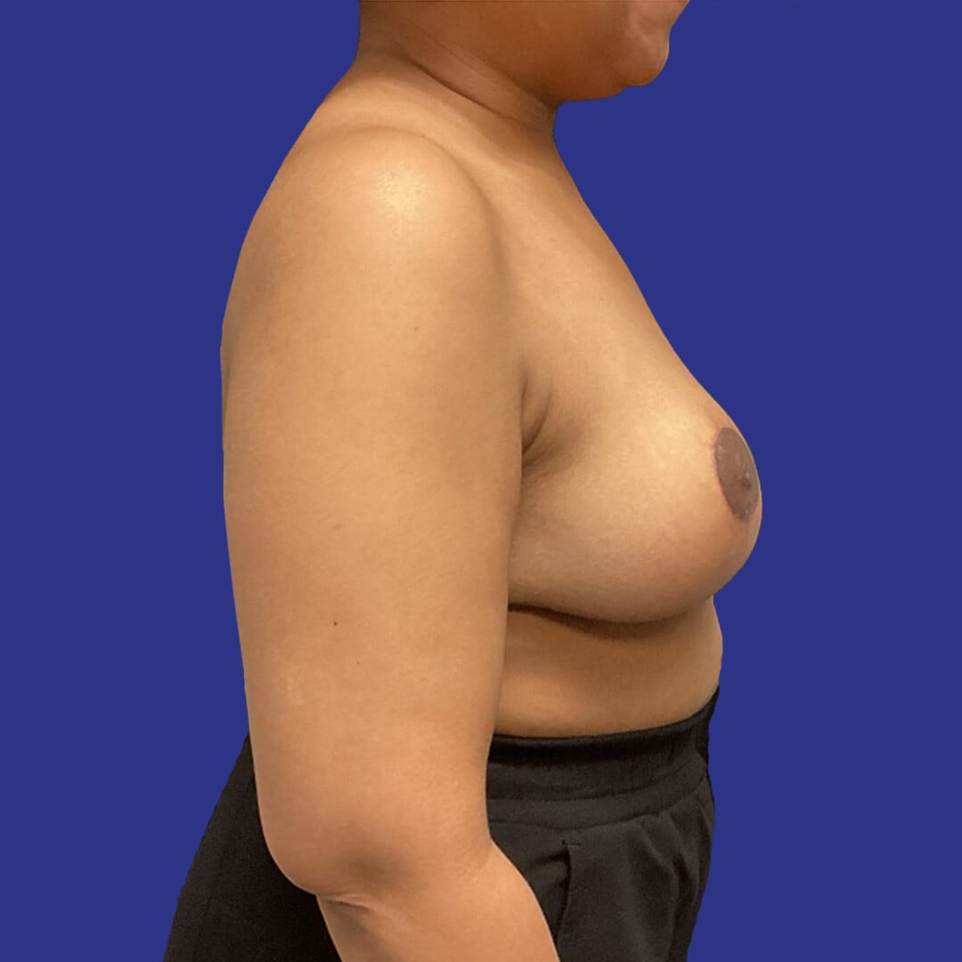 Procedure before and after - after