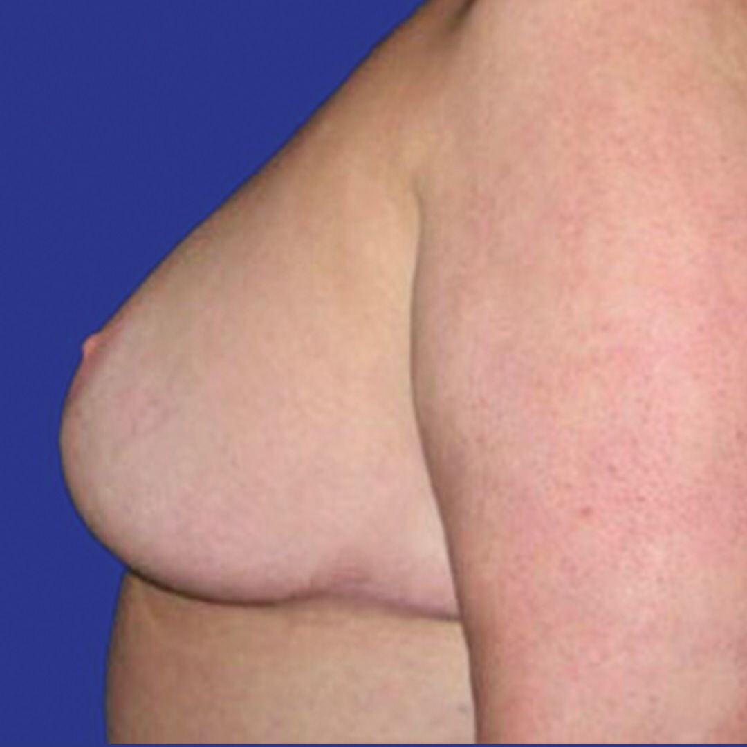 Procedure before and after - after