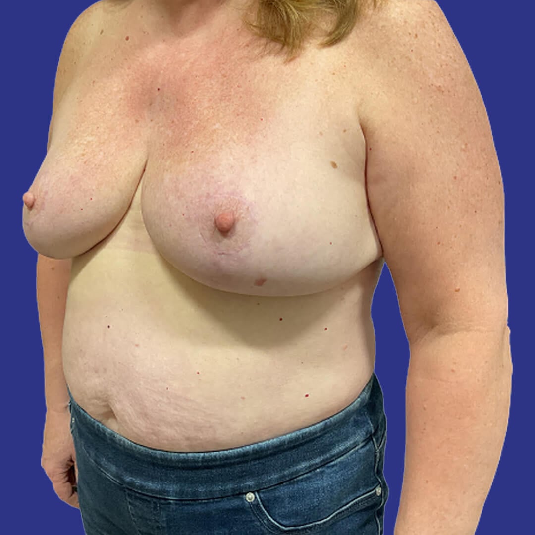 Procedure before and after - after