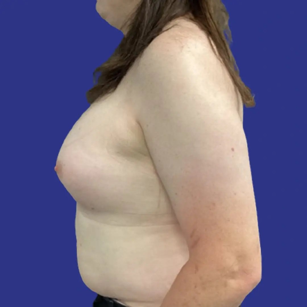 Procedure before and after - after