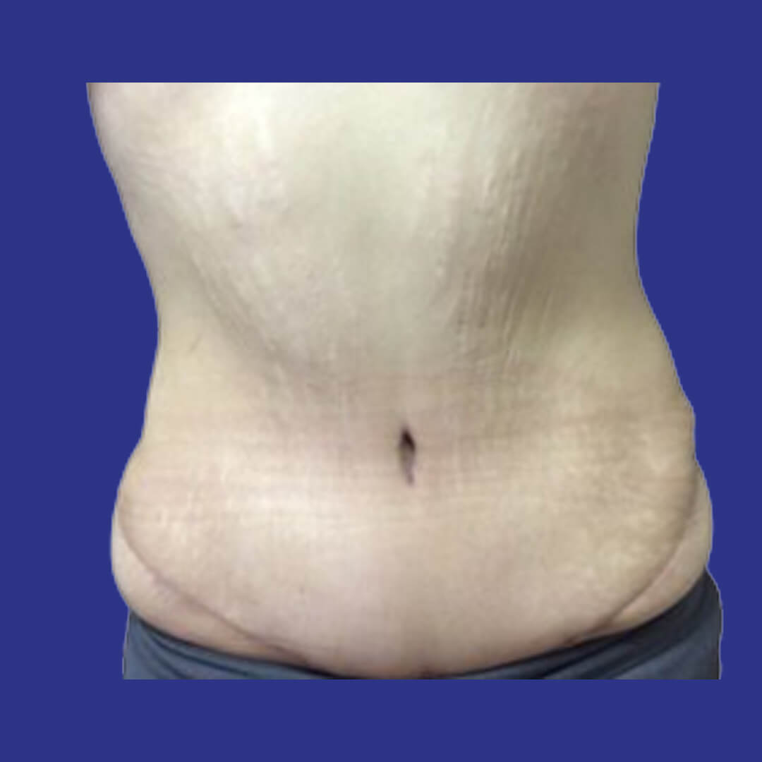 Procedure before and after - after