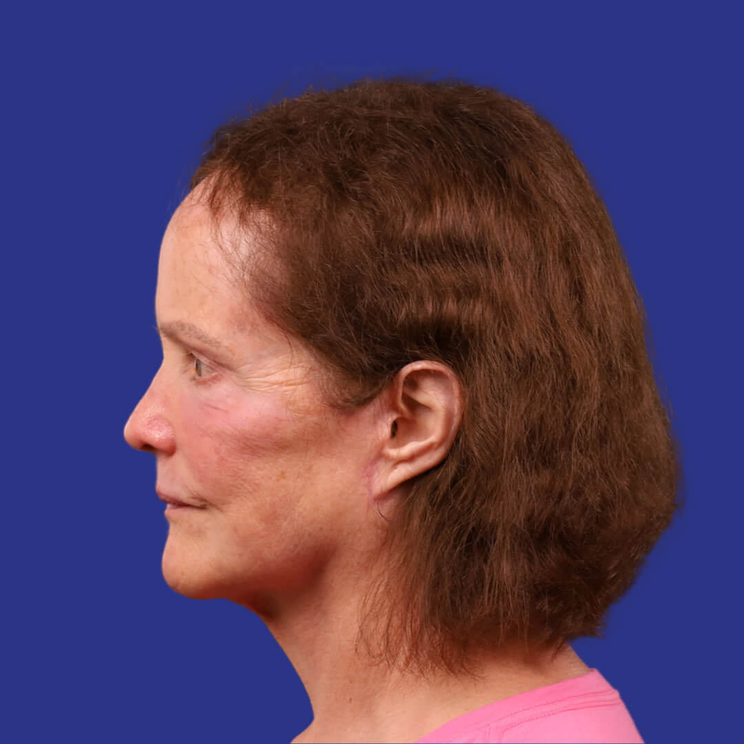 Procedure before and after - after