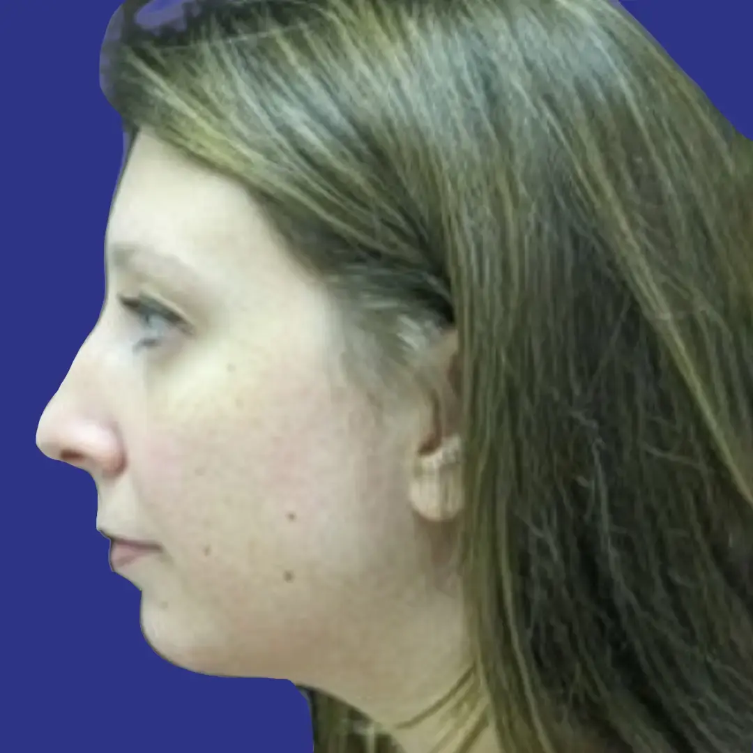 Procedure before and after - after
