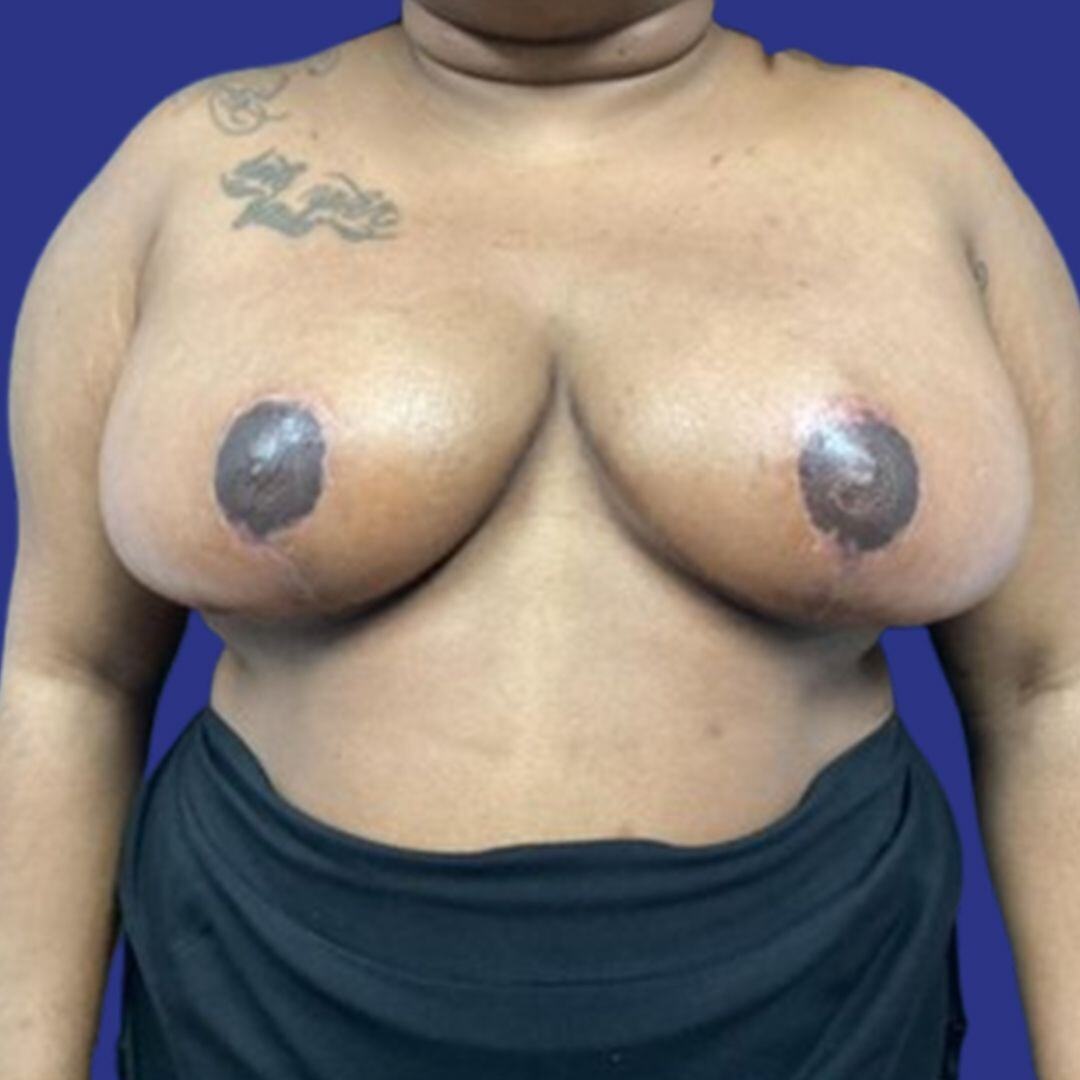 Procedure before and after - after