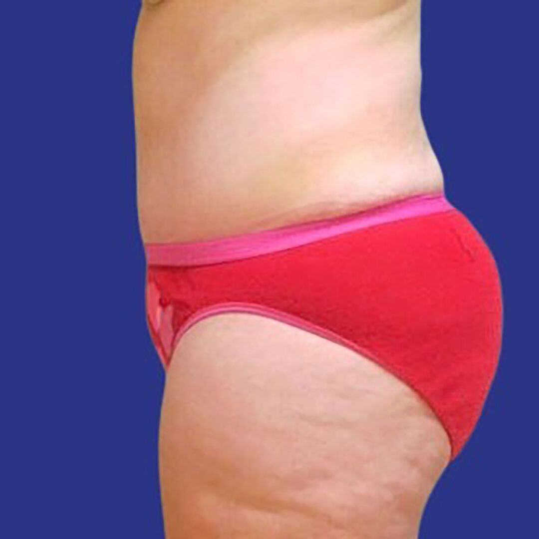Procedure before and after - after