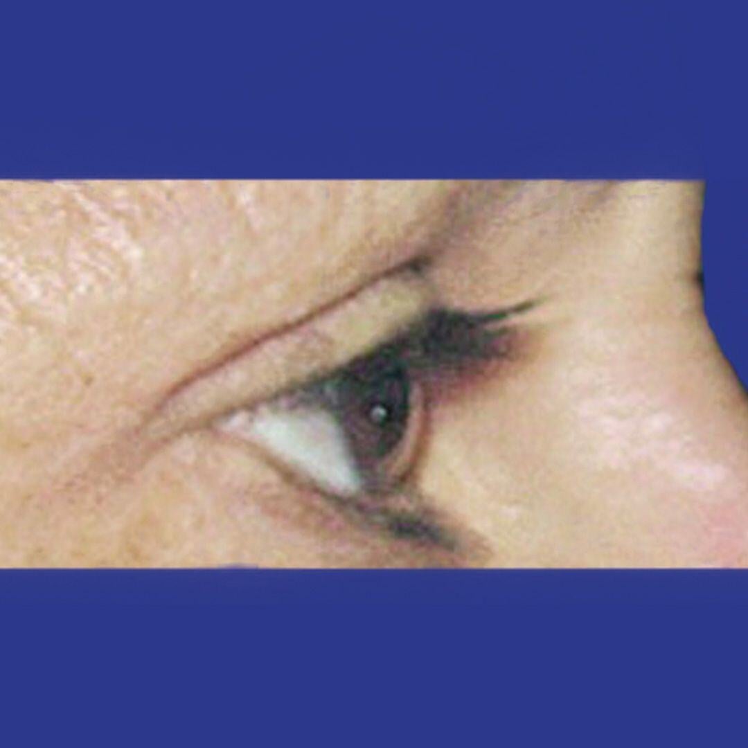 Procedure before and after - after