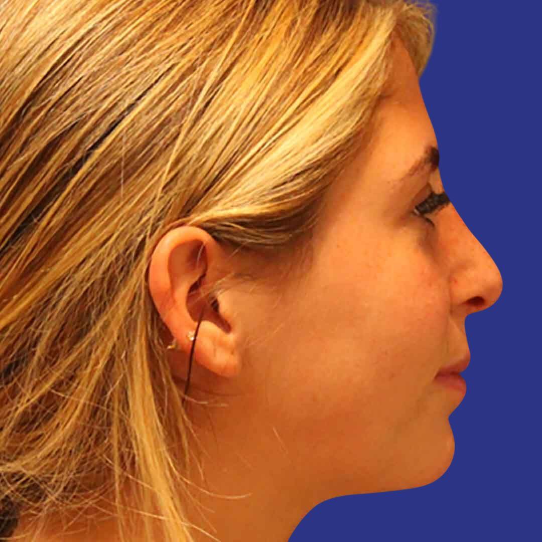 Procedure before and after - after