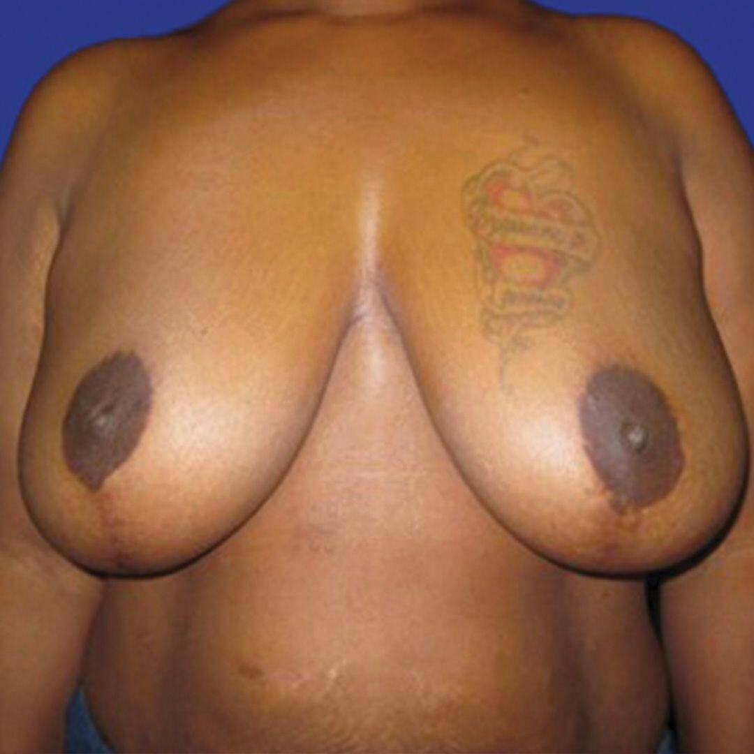 Procedure before and after - after