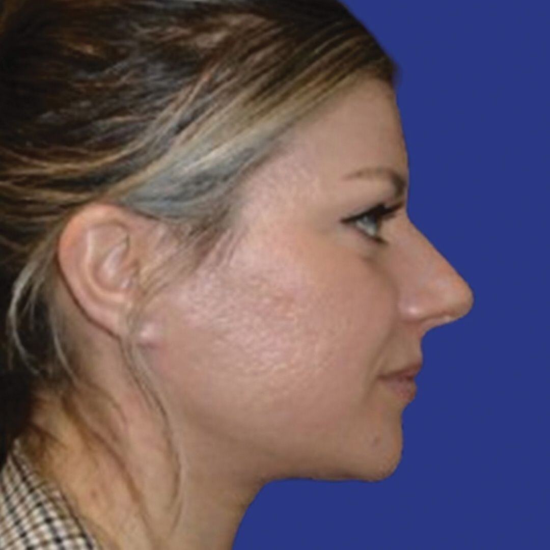 Procedure before and after - after