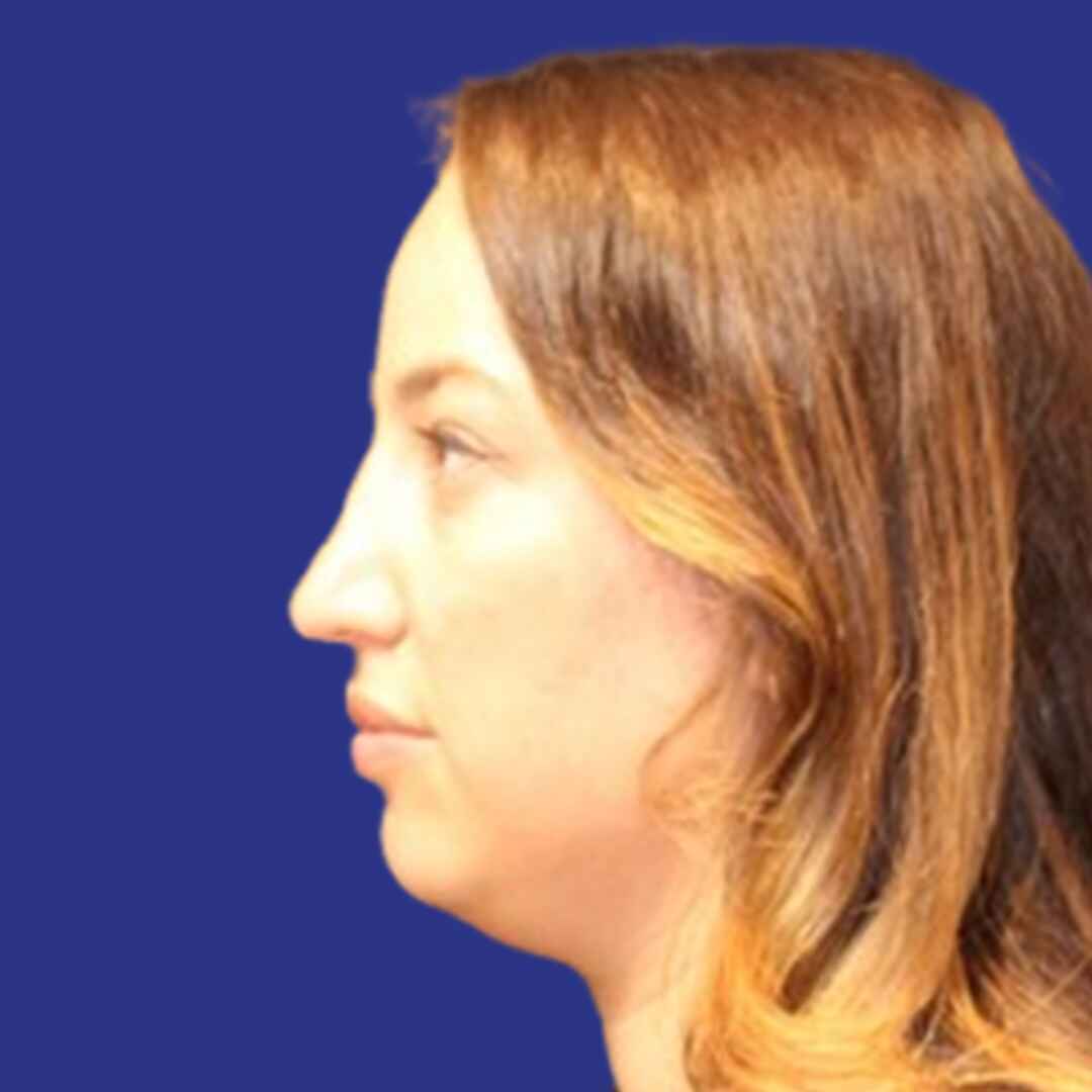 Procedure before and after - after