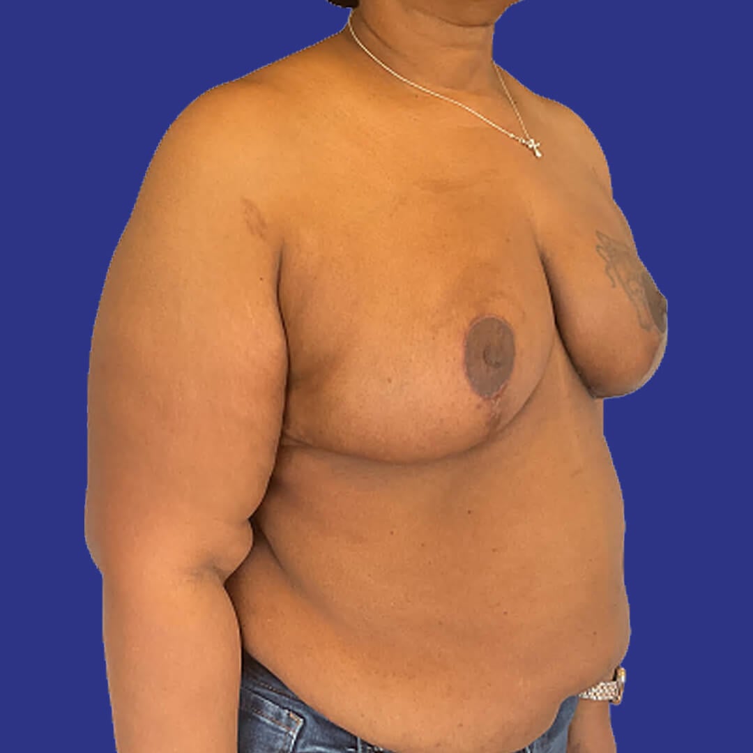 Procedure before and after - after