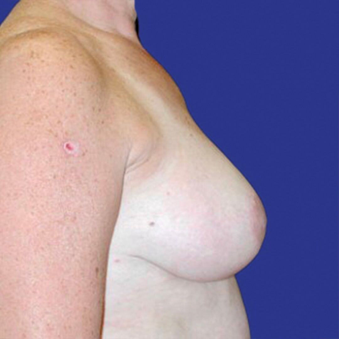 Procedure before and after - after
