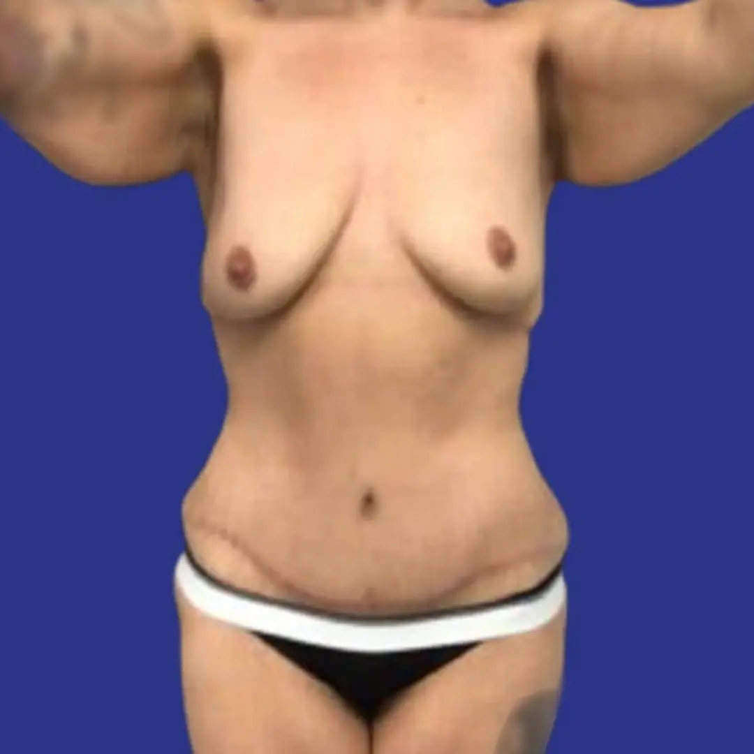 Procedure before and after - after