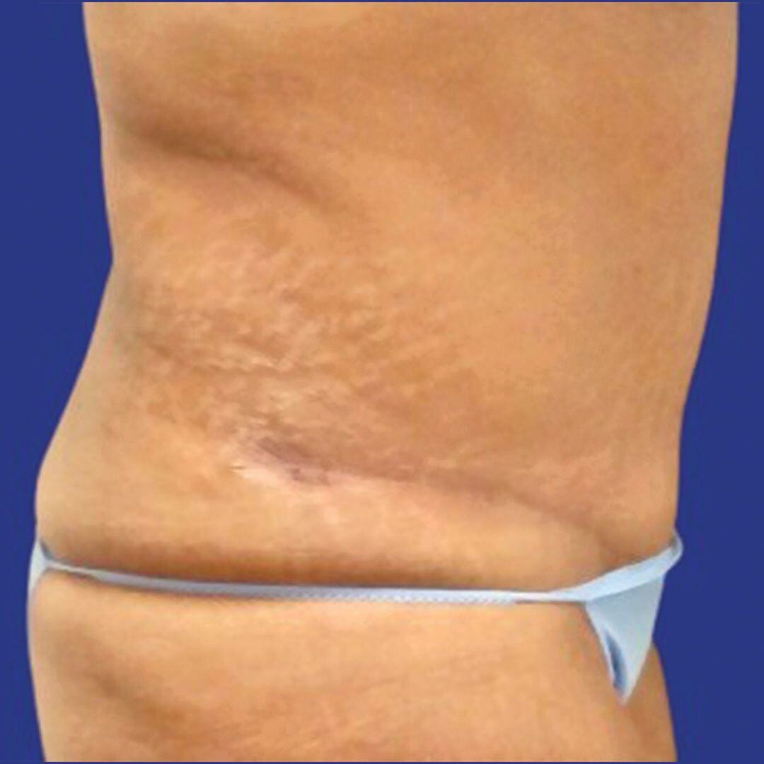 Procedure before and after - after