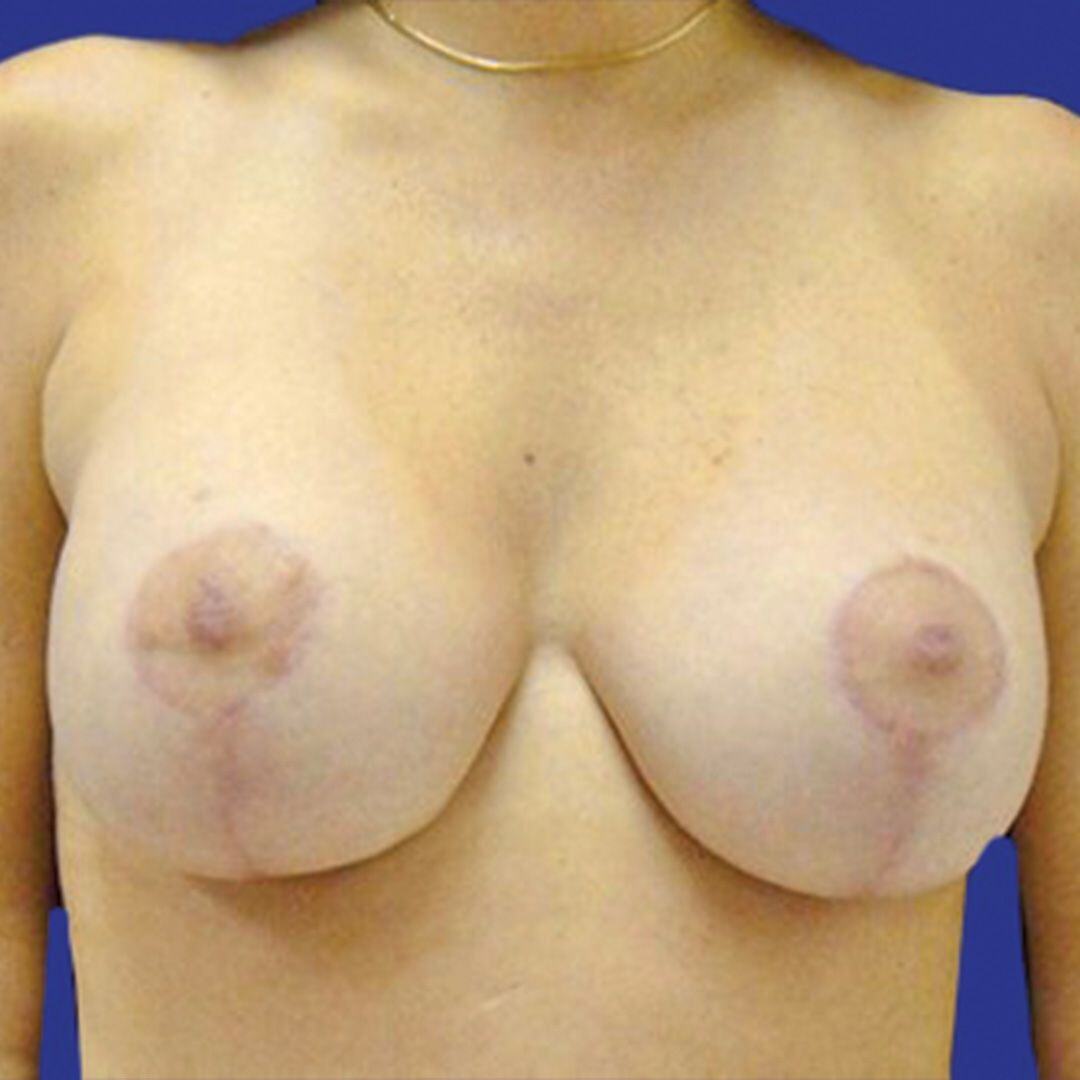 Procedure before and after - after