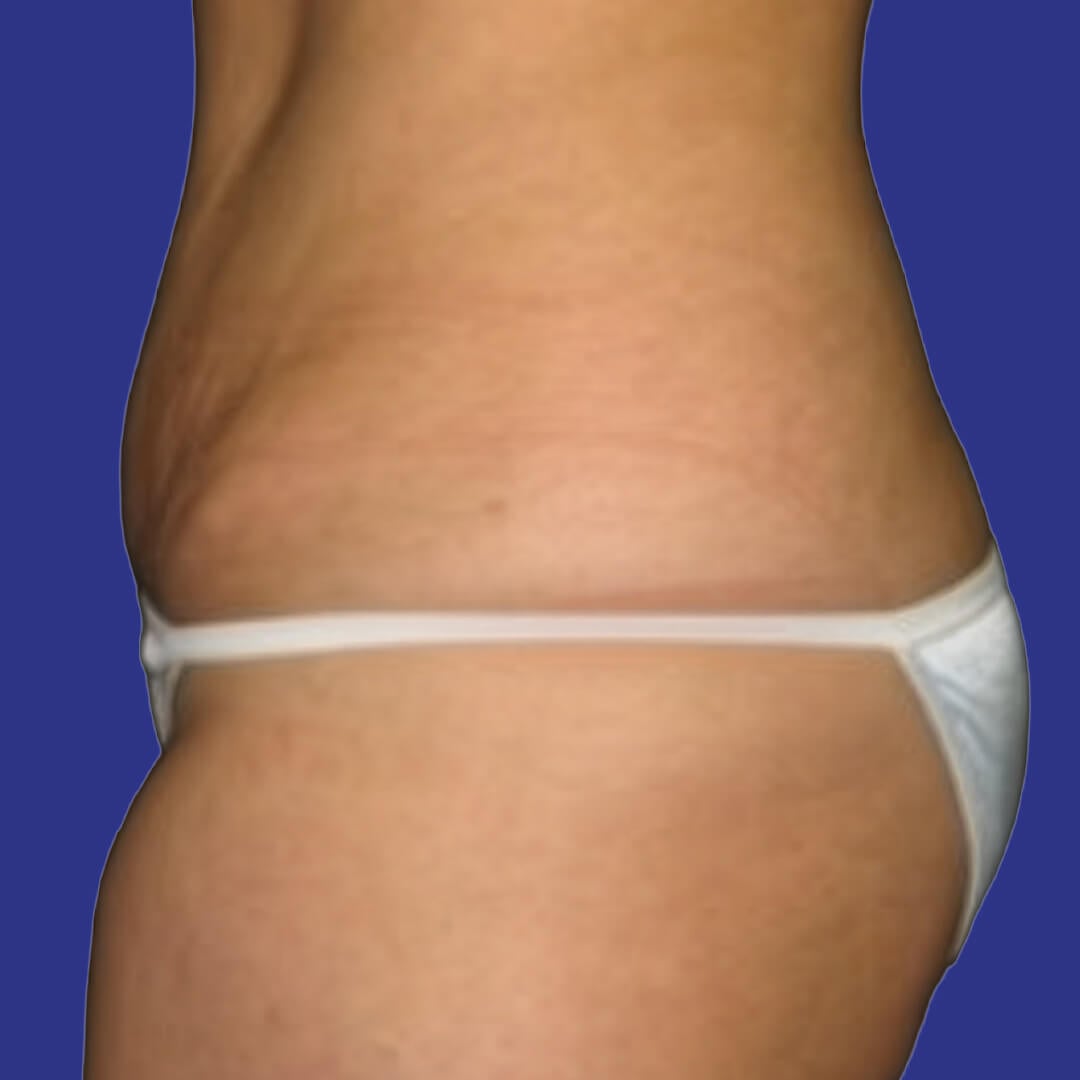 Procedure before and after - after