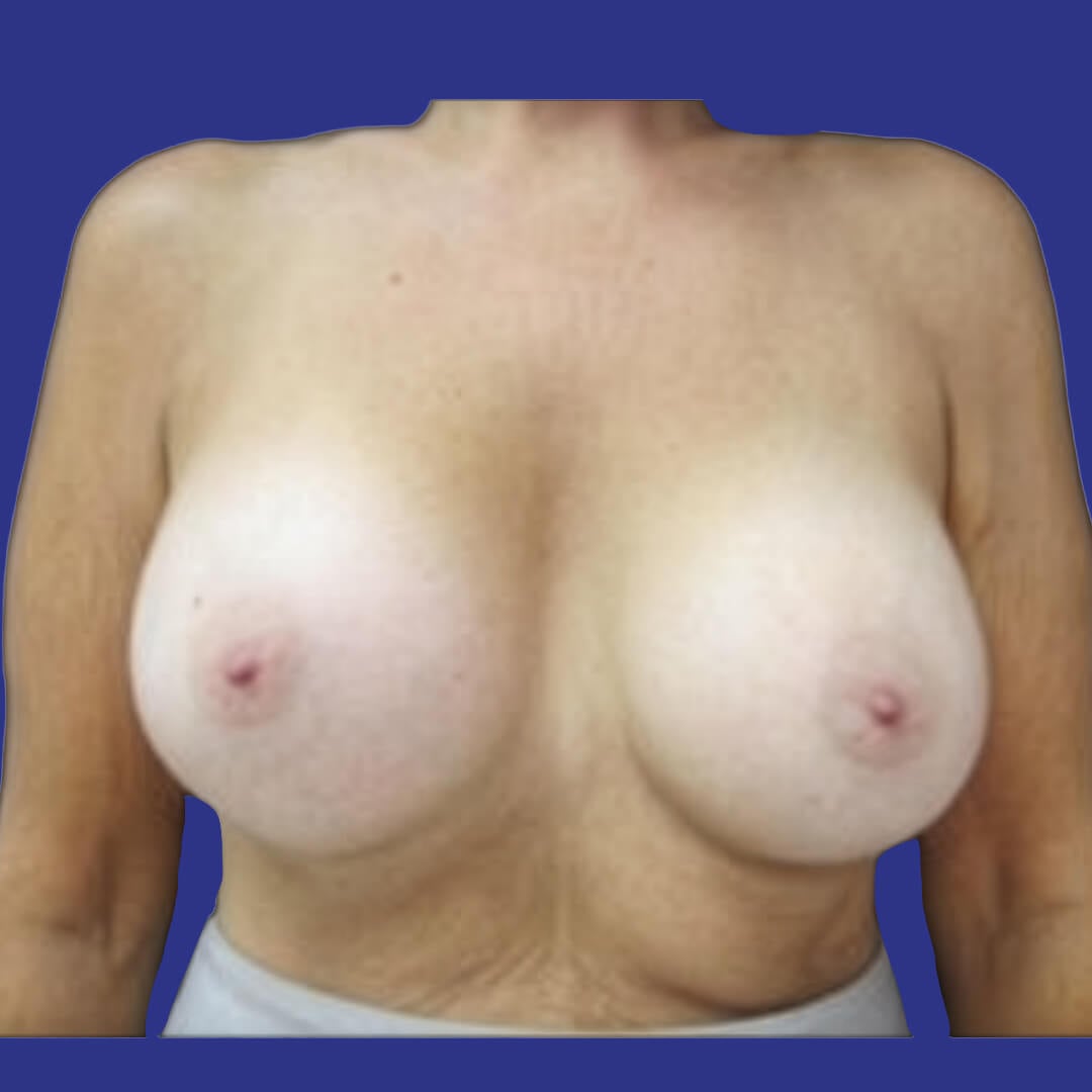 Procedure before and after - after