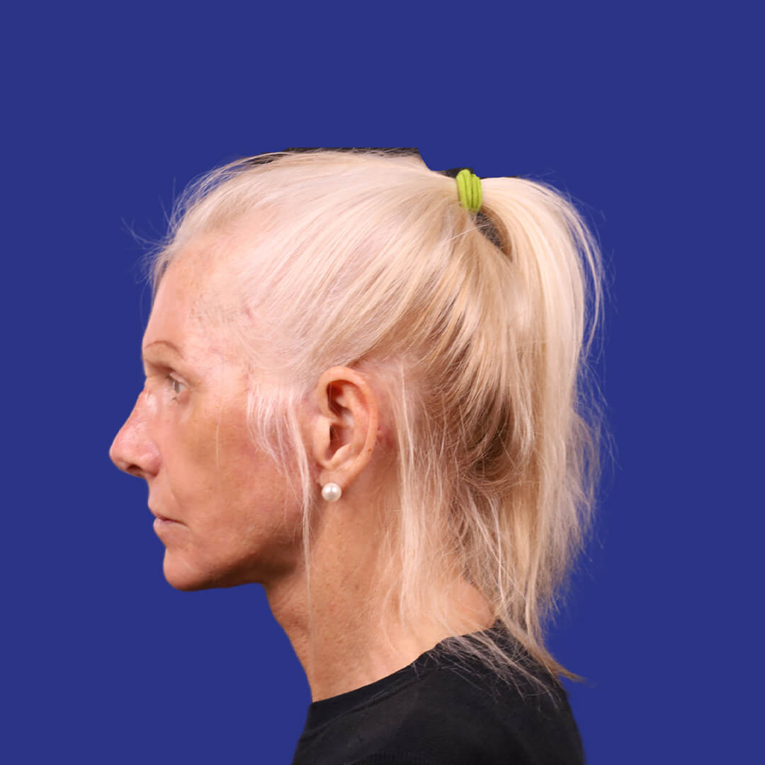 Procedure before and after - after