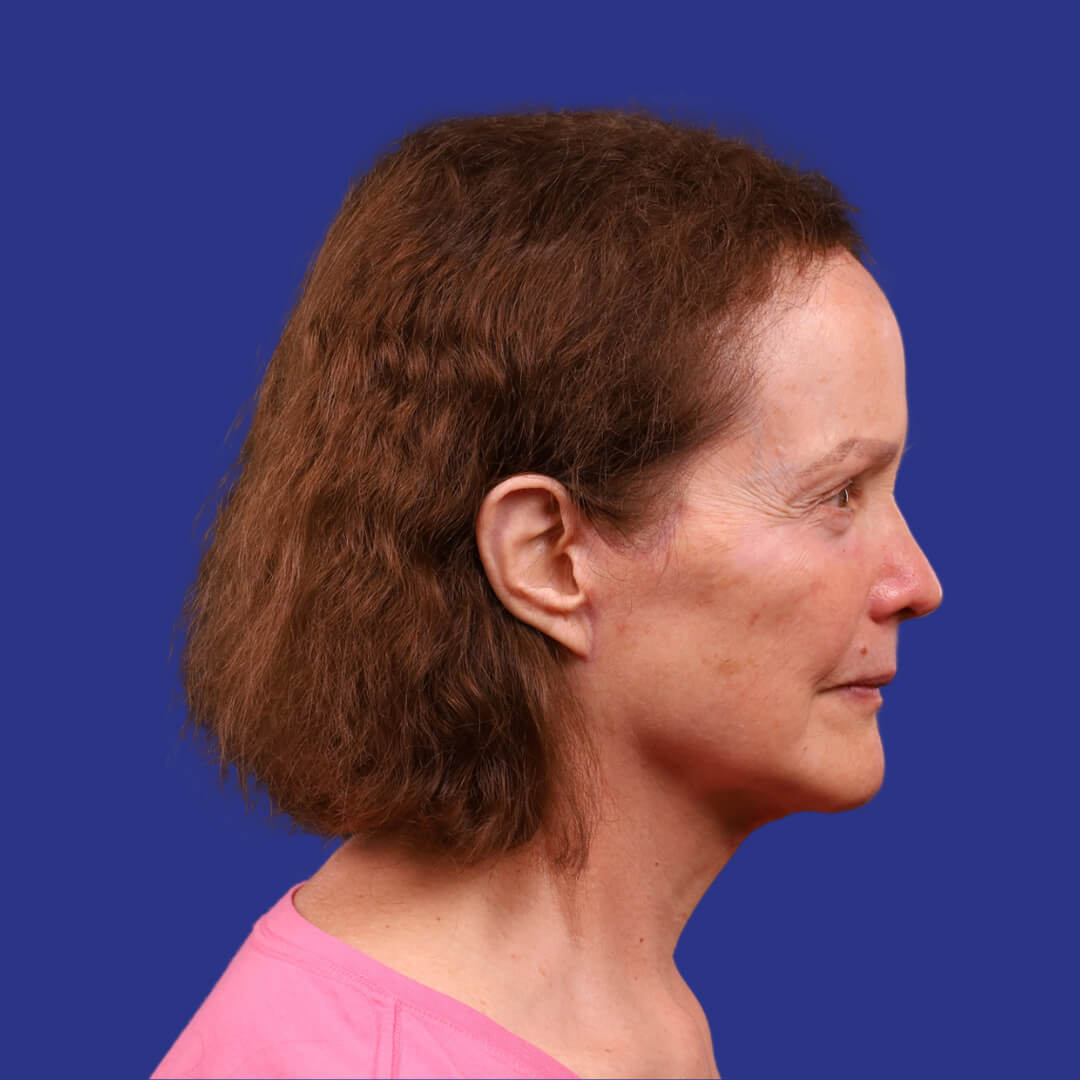 Procedure before and after - after