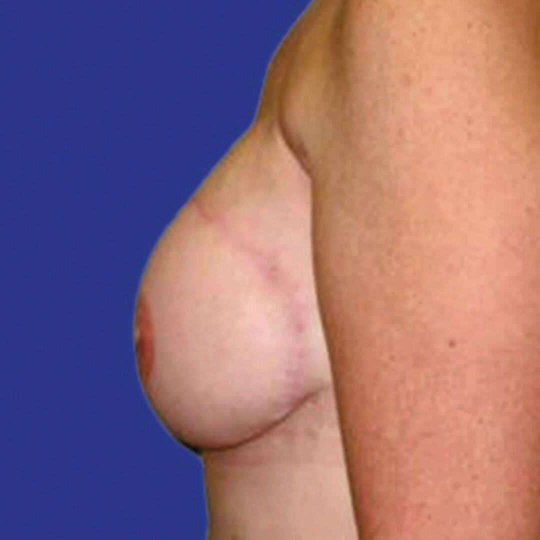 Procedure before and after - after