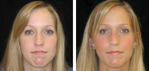 Nose Surgery before and after - after