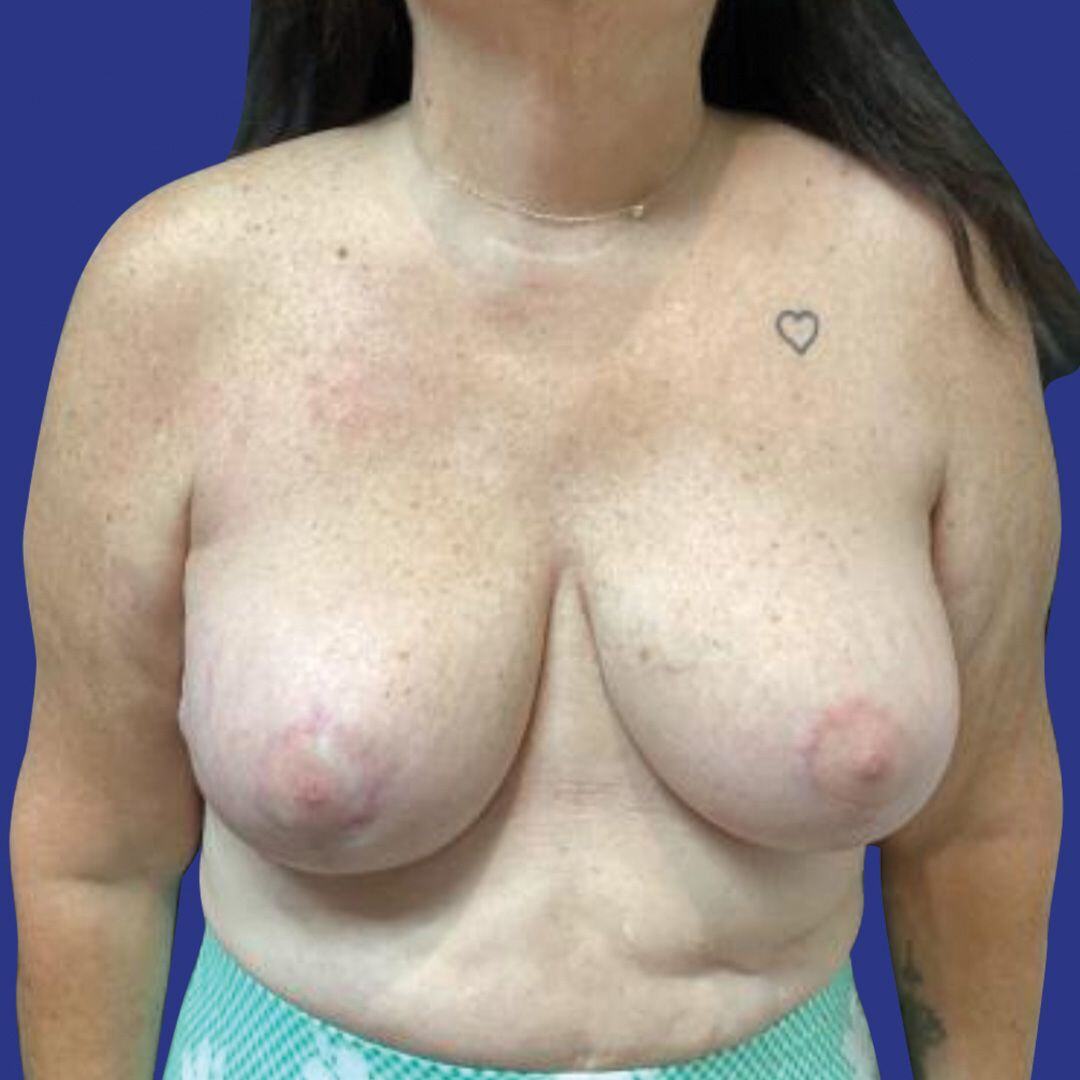 Procedure before and after - after