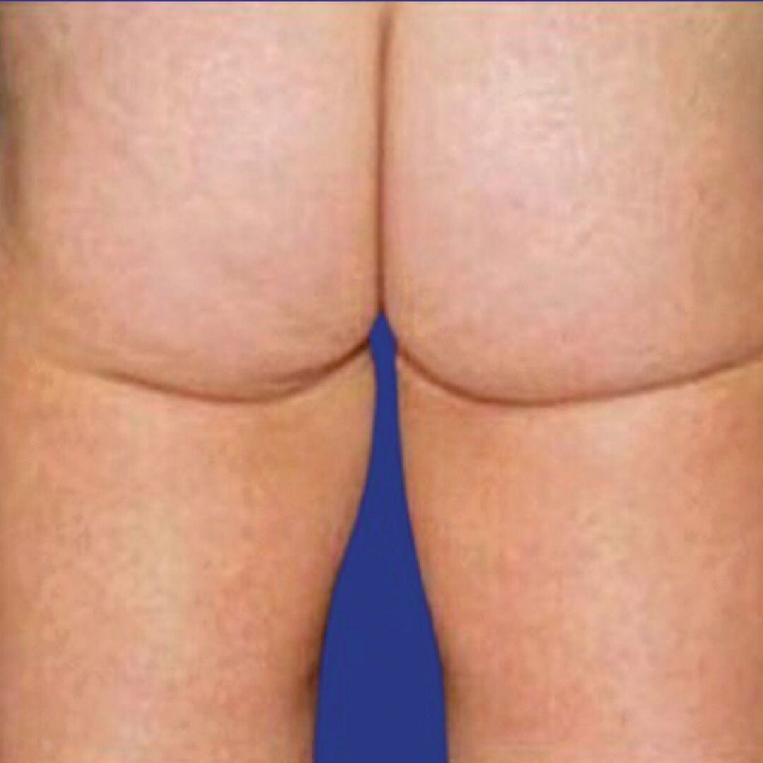 Procedure before and after - after