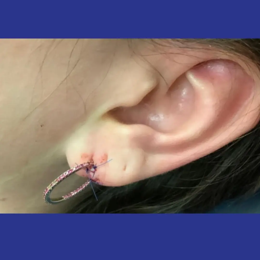 Procedure before and after - after