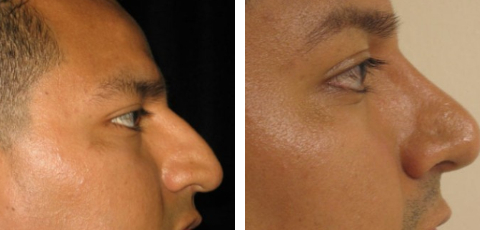 Nose Surgery before and after - after