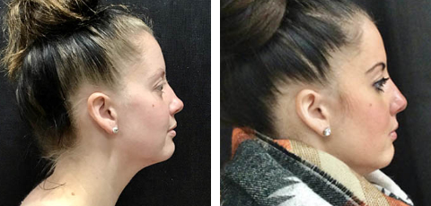 Nose Surgery before and after - after
