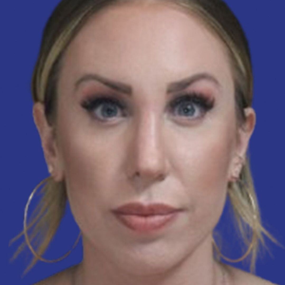 Procedure before and after - after