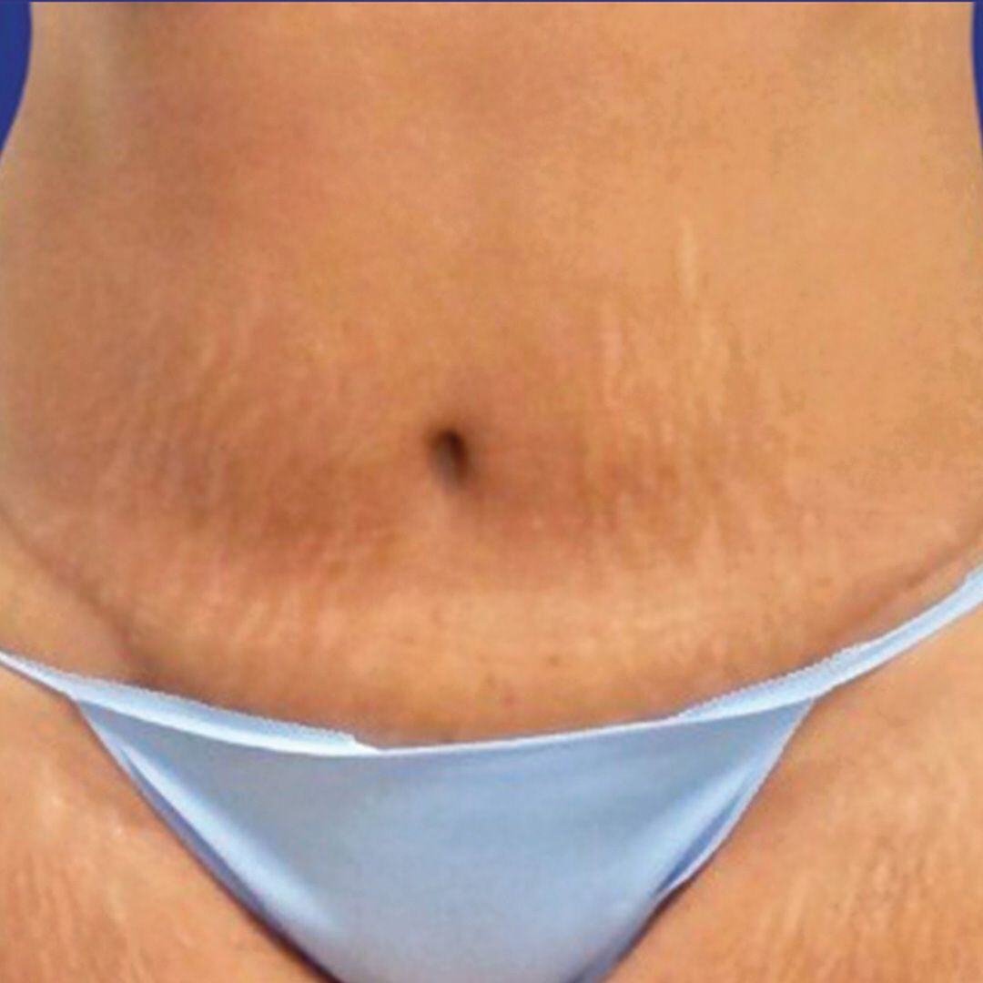 Procedure before and after - after