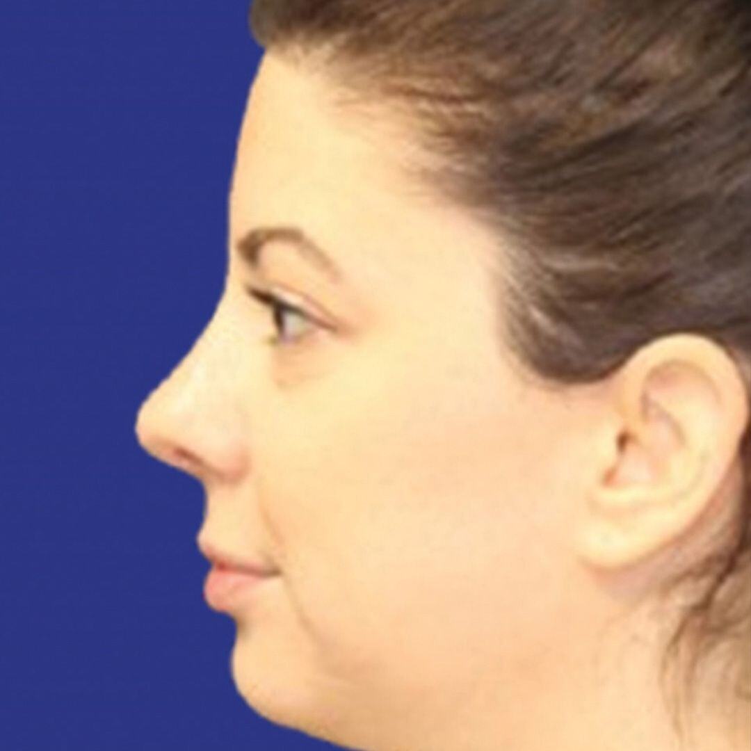 Procedure before and after - after