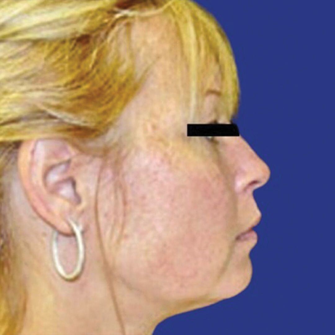 Procedure before and after - after