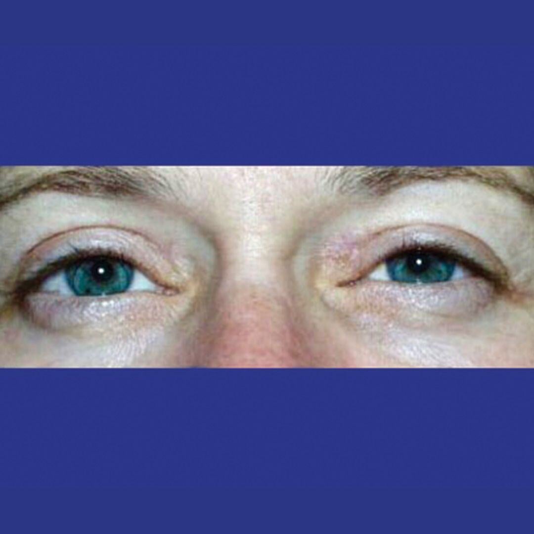 Procedure before and after - after