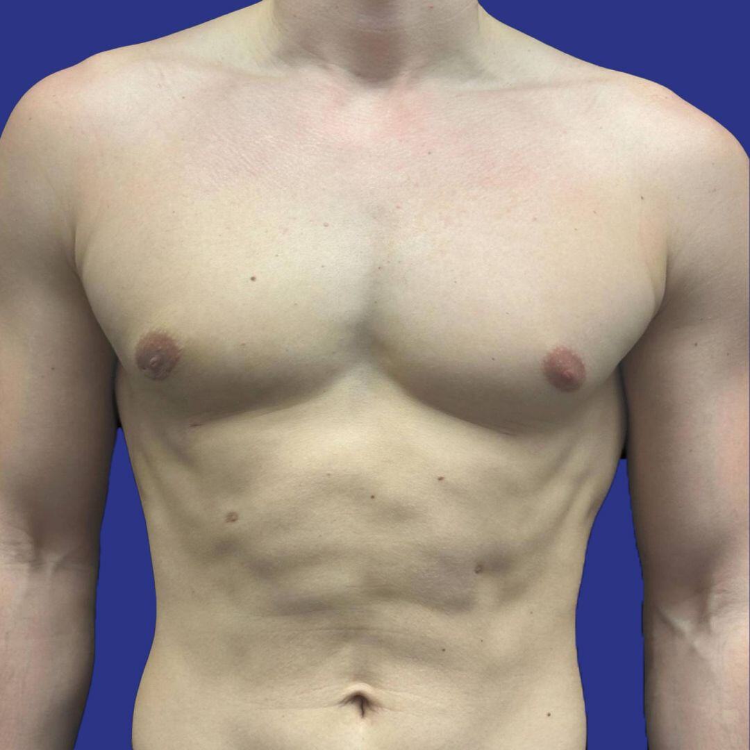 Procedure before and after - after